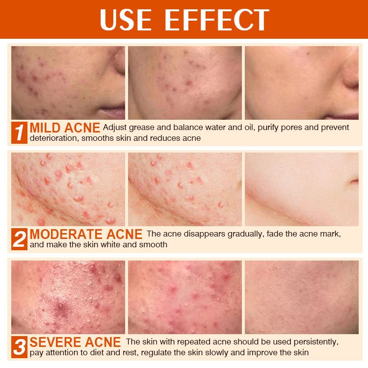 MOOYAM Acne Removal Cream